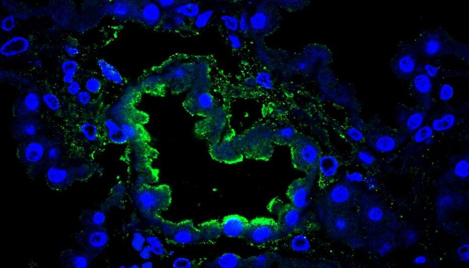 Novo coronavírus infecta o cérebro de uma criança; em verde está o Sars-CoV-2 e em azul é o núcleo (DNA) das células do plexo coroide. Foto: Ismael Gomes/Karina Karmirian (UFRJ/IDOR)