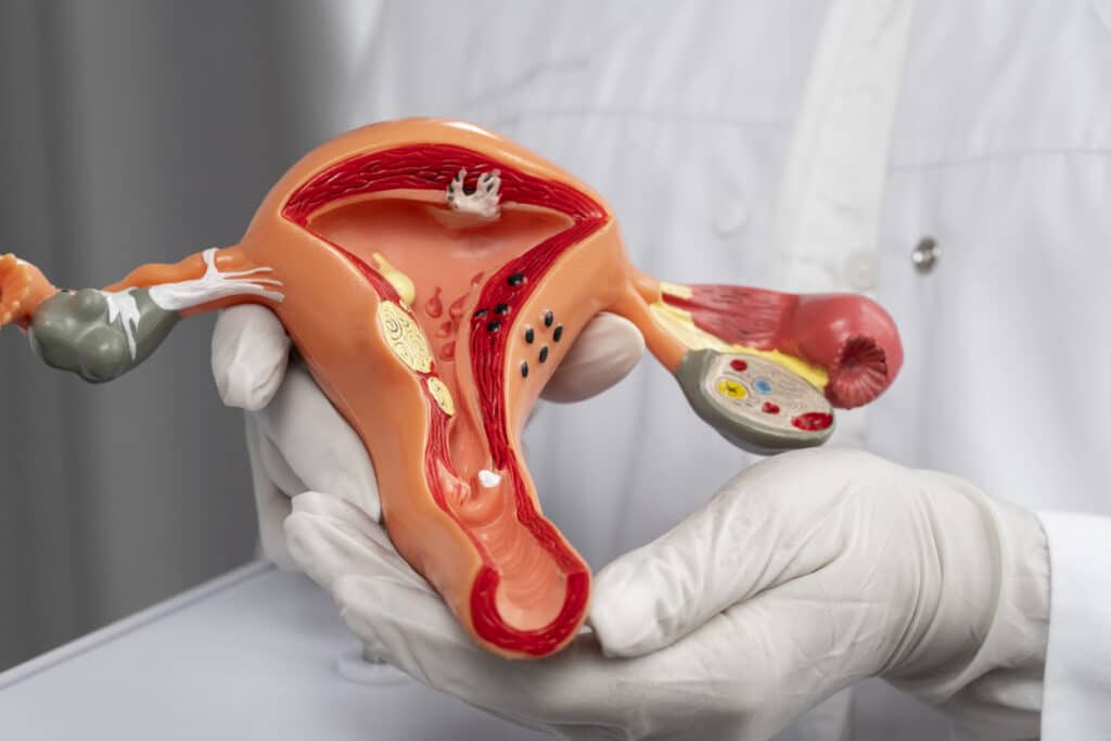 Um médico de luvas com uma réplica de Modelo do trato gastro-intestinal para falar sobre câncer no canal anal