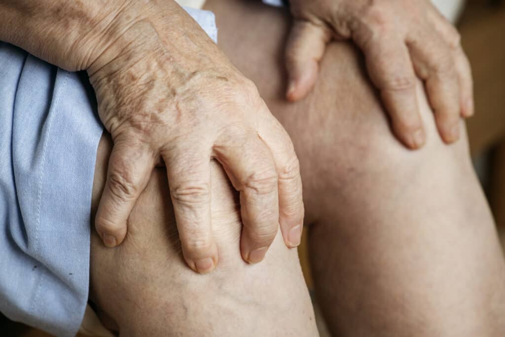 Duas mãos segurando um joelho com artrose de uma idosa de saia azul
