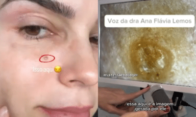 Vanessa alerta sobre a importância da prevenção ao detectar câncer de pele. Foto: Montagem Portal ES360