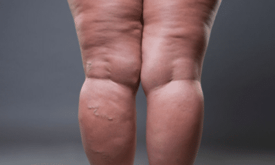 Lipedema é frequentemente confundido com obesidade ou linfedema. Foto: Reprodução