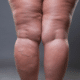 Lipedema é frequentemente confundido com obesidade ou linfedema. Foto: Reprodução