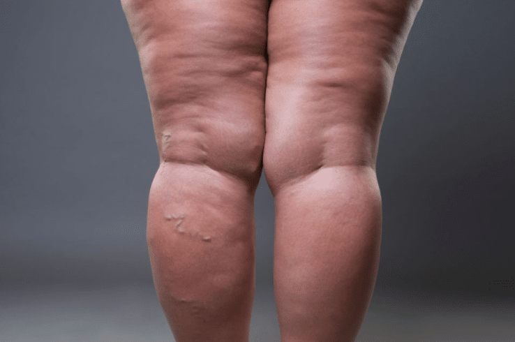 Lipedema é frequentemente confundido com obesidade ou linfedema. Foto: Reprodução