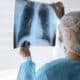 Bronquiolite obliterante é chamada de pulmão de pipoca. Foto: Freepik