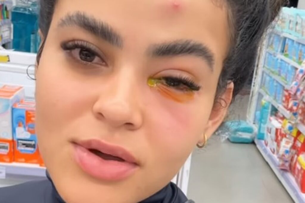 Larissa de Jesus viralizou ao relatar inflamação ocular provocada por inseto durante o banho; vídeo soma milhões de visualizações