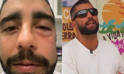 O surfista Pedro Scooby apareceu com o rosto inchado após uma limpeza dentária e relatou que a inflamação afetou até a região dos olhos