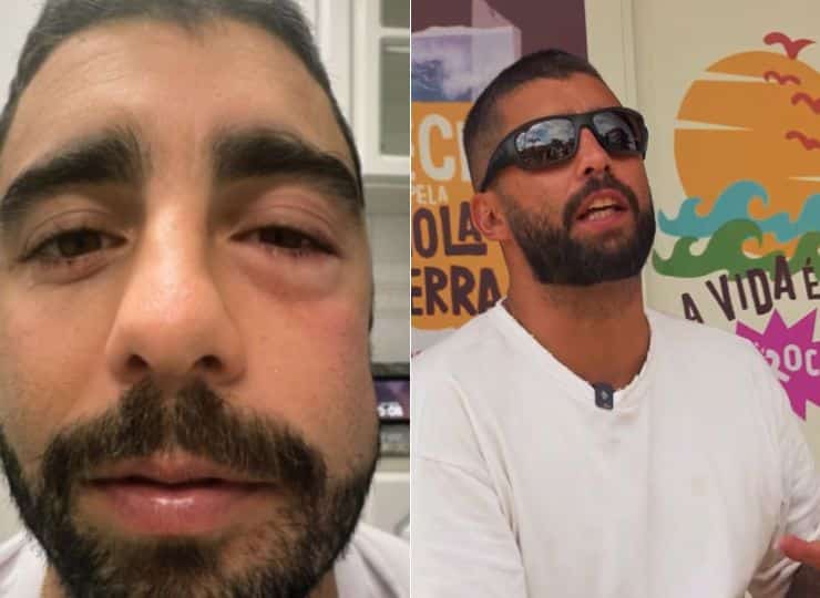 O surfista Pedro Scooby apareceu com o rosto inchado após uma limpeza dentária e relatou que a inflamação afetou até a região dos olhos
