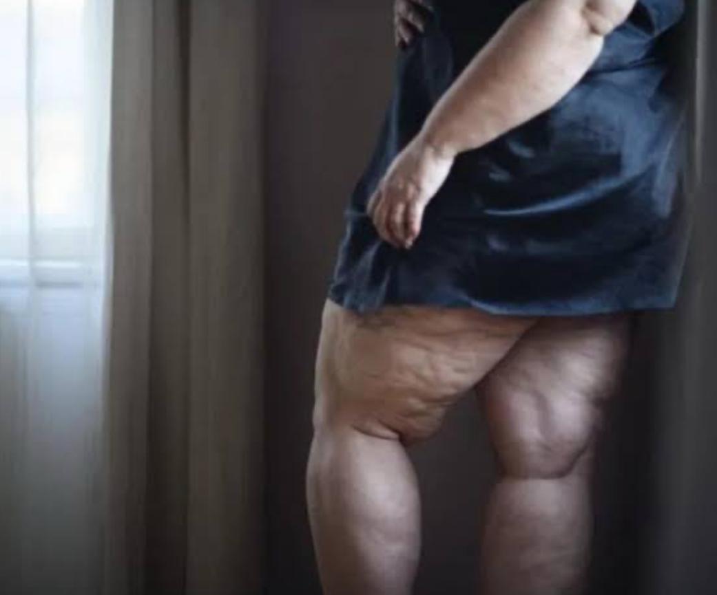 Especialista destaca como o lipedema permanece subdiagnosticado no Brasil e aponta os sinais de alerta que podem ajudar no reconhecimento precoce da doença. Foto: Pexels