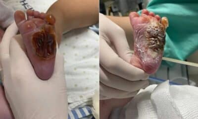 Pé do bebê apresenta queimaduras graves após procedimento realizado no Hospital Jayme Santos Neves, na Serra