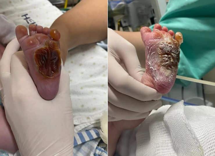 Pé do bebê apresenta queimaduras graves após procedimento realizado no Hospital Jayme Santos Neves, na Serra