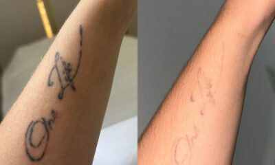 Remoção de tatuagens depende de técnica profissional, disciplina e cuidados adequados com a pele. Foto: Divulgação