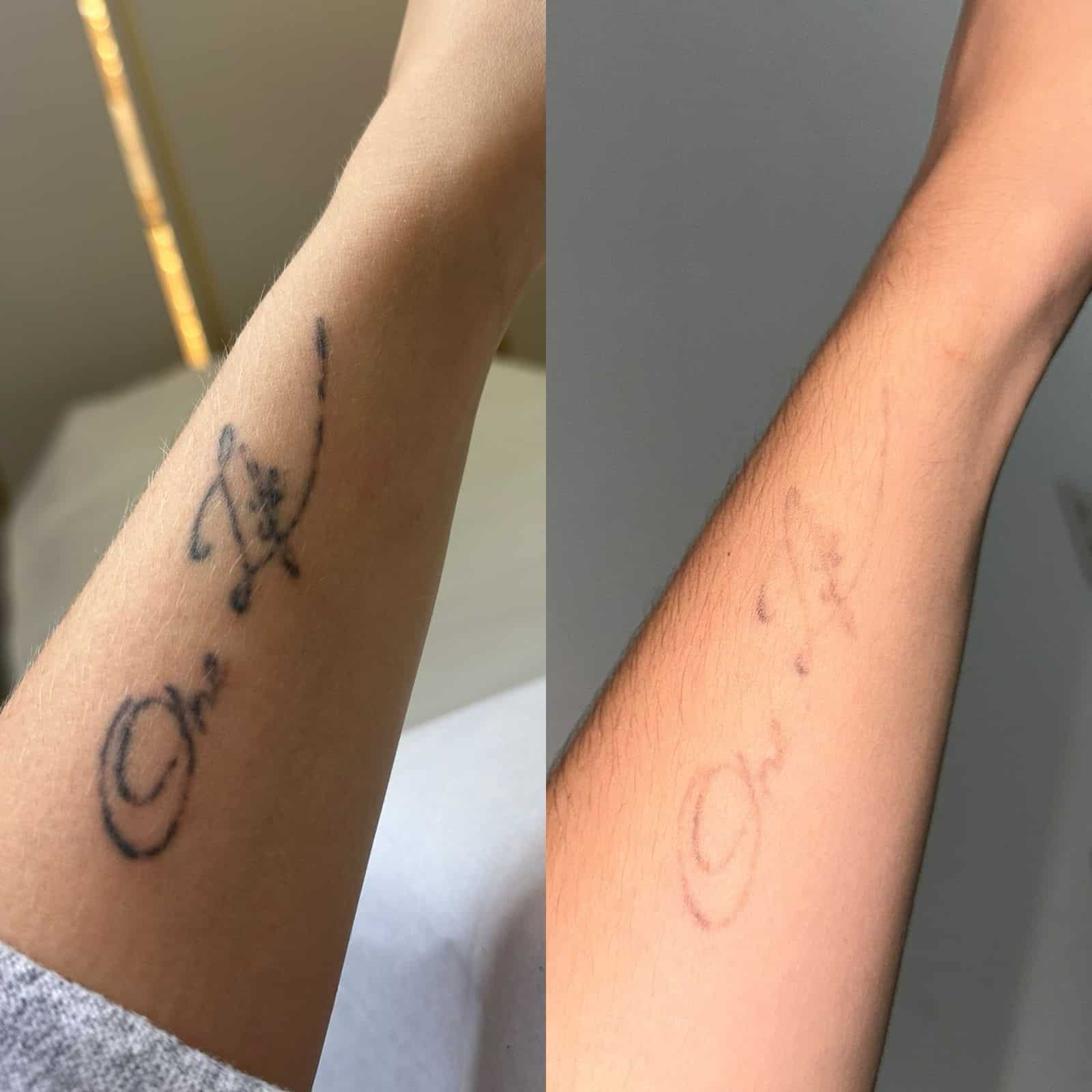 Remoção de tatuagens depende de técnica profissional, disciplina e cuidados adequados com a pele. Foto: Divulgação