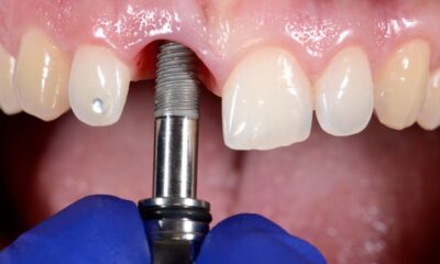 “Implantes dentários exigem cuidado de diabéticos”