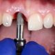 “Implantes dentários exigem cuidado de diabéticos”
