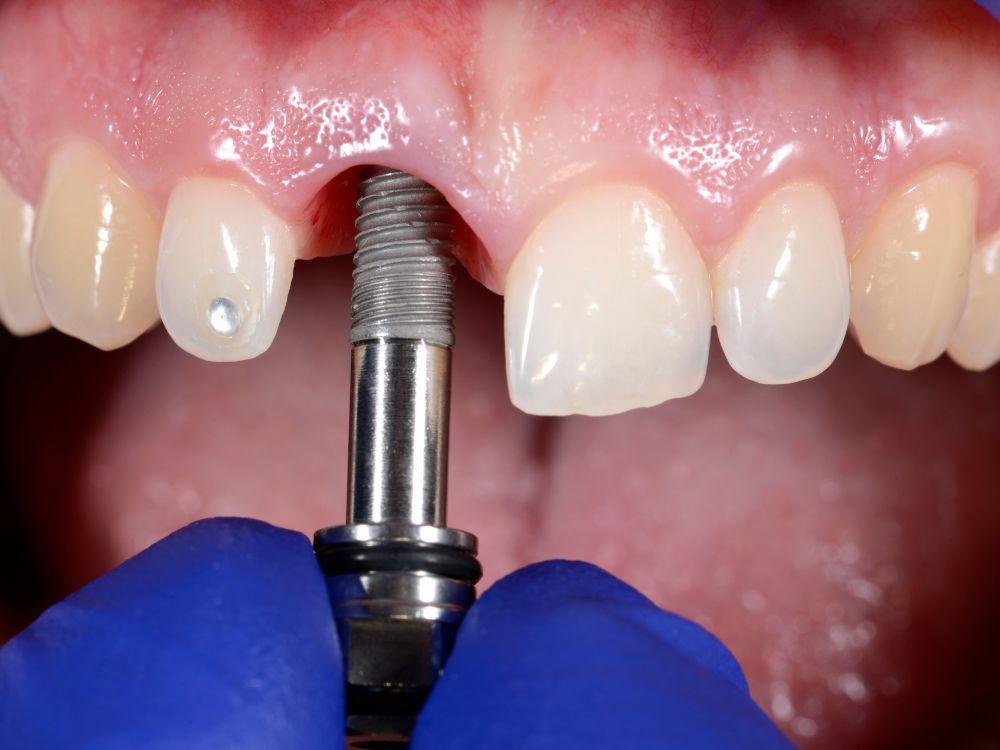 “Implantes dentários exigem cuidado de diabéticos”